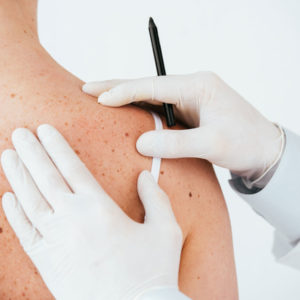 Dermatologist hands with gloves on examining a woman shoulder for skin tags and wart removable.