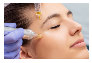 Lady receiving SkinPen microneedling.