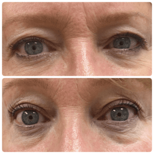 Close up eyes before and after pictures of an eye lift.