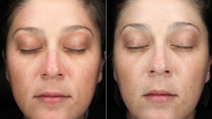 Before and after of a oxygen treatment of a lady's face.