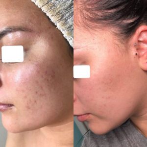 Before and after acne treatment of a young girl's face.