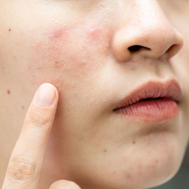 Young Asian woman's face with acne.